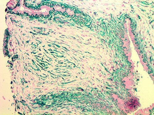 IHC of NGFR on an FFPE Breast Fibroadenoma Tissue
